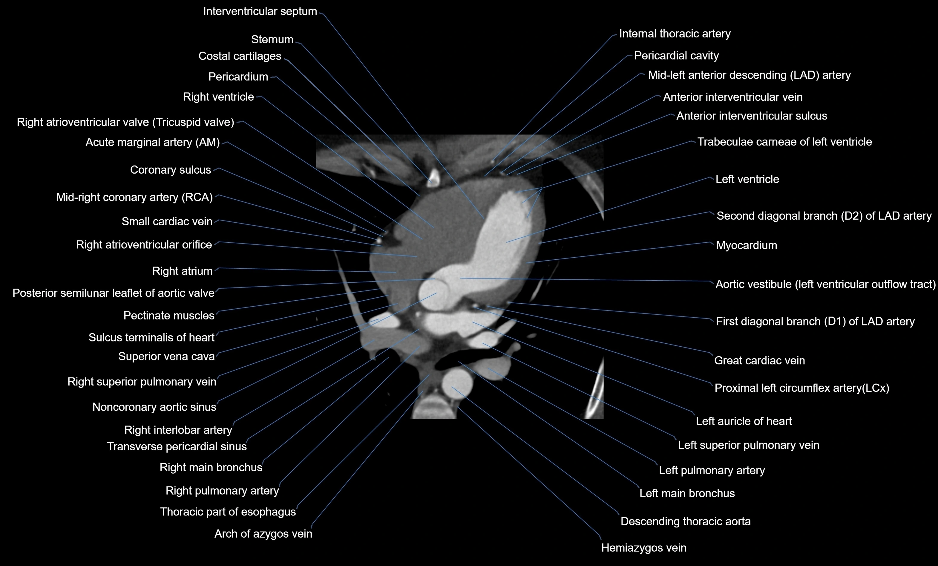 CT heart (coronary angiogram) four chamber view  cross sectional anatomy labelled radiology image -00024.webp